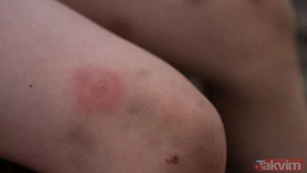 Lyme Hastalığı Bulaşıcı Mı? Lyme Hastalığına Neden Olan Bakteriye Birçok Memeli Türü Ev Sahipliği Yapabilir, Ancak En Önemli Rezervuarlar Geyiklerdir. Hastalık,...