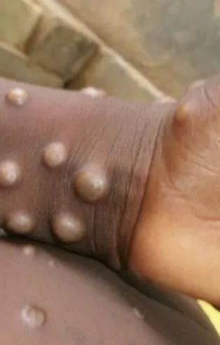 Maymun çiçeği virüsü bir ülkede daha görüldü! Maymun çiçeği nasıl bulaşır? Aşılar etkili mi? Türkiye'de maymun çiçeği vakası görüldü mü?