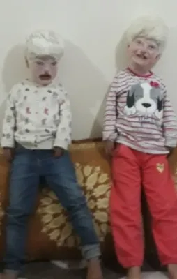 Albino kardeşler görenlerin yüreklerini burkuyor