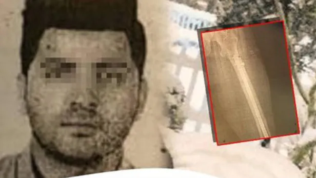 ameliyat-masasinda-kabus-korkunc-gercek-xray-cihazinda-ortaya-cikti-1605260703951.jpg Ameliyat masasında kabus! Korkunç gerçek Xray cihazında ortaya çıktı-1