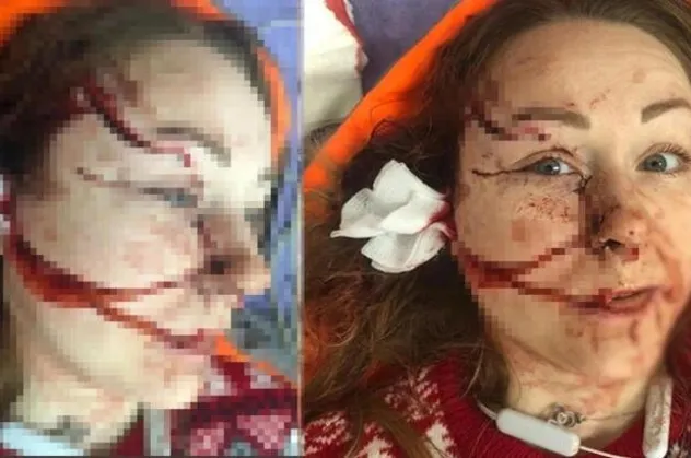Boşanmak istediği kocası yüzünü falçatayla parçalayan Ukraynalı Hanna'dan haber var!