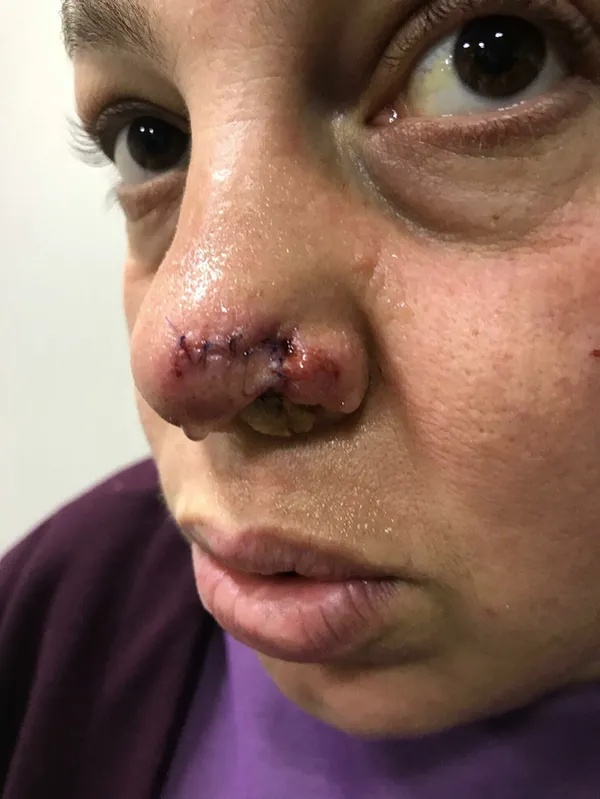 yuruyus-yaparken-pitbull-saldirisina-ugradi-burnu-parcalandi-1638539568519.jpg Yürüyüş yaparken pitbull saldırısına uğradı! Burnu parçalandı-2