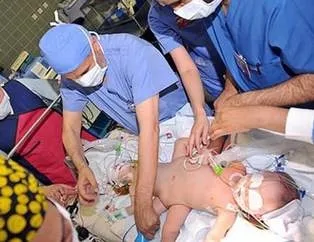 Yapışık ikizler 9 saatte ayrıldı