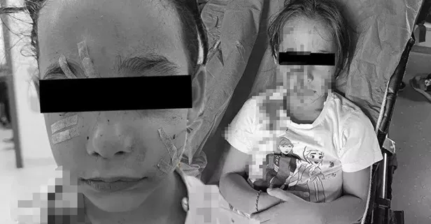 İstanbul Esenyurt'ta kuduz alarmı! Başıboş köpek 6 yaşındaki kıza saldırdı