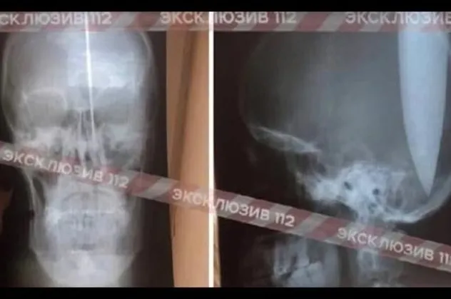 Rusya'da nefes alamayan adam kafasını deldi