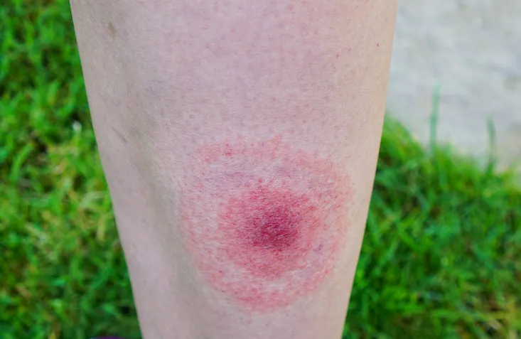 Lyme hastalığı nedir? AIDS'ten bile tehlikeli olan lyme hastalığı bulaşıcı mıdır? Lyme hastalığı tedavi edilebilir mi?  - 11