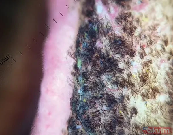 Akılalmaz hastalık doktorları bile şoke etti! Ağzının içinde bir anda başladı şimdi bakmak cesaret ister - 3