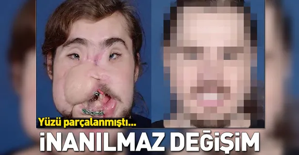 Yüzü parçalanan adamın inanılmaz değişimi!