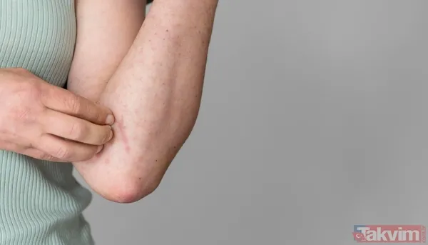 Doktorlar gece başlayan kaşıntısını önemsemedi: Dokuz yıl sonra organ nakliyle hayata tutundu - 4