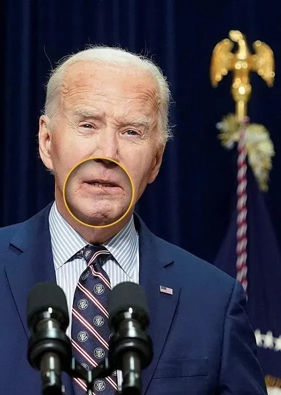biden-cilt-kanseri-cikti-teshis-kondu-gizlice-ameliyat-oldu-1757062801960.jpeg Biden daha önce çenesindeki iz ile gündeme gelmişti, Reuters
