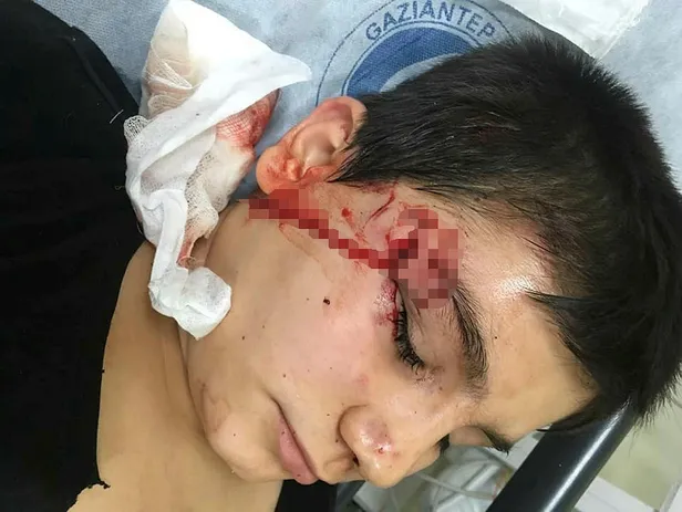 Gaziantep'te pitbull dehşeti! 12 yaşındaki çocuğa saldırdı-3