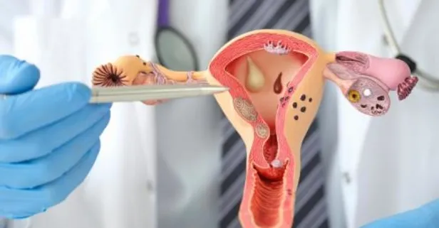 Uzmanı kadınlarda sık görülen 5 hastalığı açıkladı!