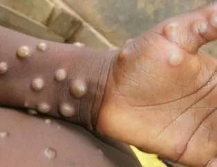 Türkiye’de maymun çiçeği vakası görüldü mü?