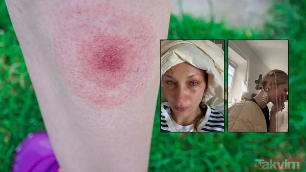 Model Bella Hadid, Uzun Süredir Mücadele Ettiği Lyme Hastalığını Sosyal Medyada Açıkladı. Hastalığın Yol Açtığı Yorgunluk Ve Sağlık Sorunları Nedeniyle Zaman...