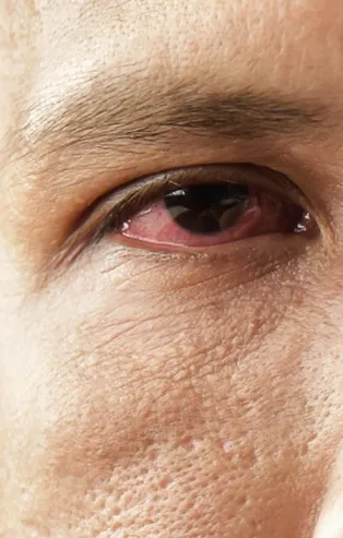 Çare kendi kanınızda! Göz kuruluğuna dikkat!