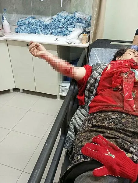 yine-kopek-saldirisi-dogo-argentino-cinsi-kopegin-saldirdigi-kadin-hastaneye-kaldirildi-1703595186402.jpeg Yine köpek saldırısı! Dogo Argentino cinsi köpeğin saldırdığı kadın hastaneye kaldırıldı-3