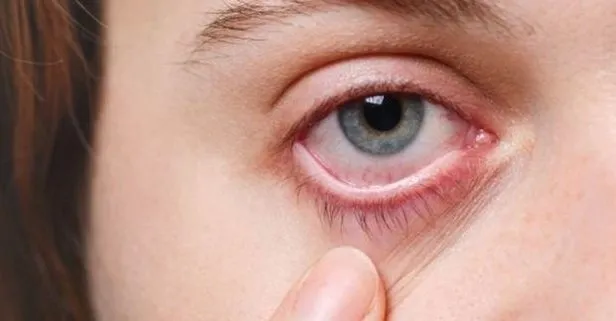 Tehlike göz ucunda! Adenovirüs salgınıyla görme kayıpları yaşanabilir