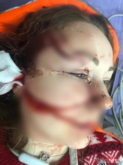 Genç kadına falçatalı dehşet! Boşanmak isteyen Ukraynalı eşi Anna Butim’in yüzünü parçaladı!