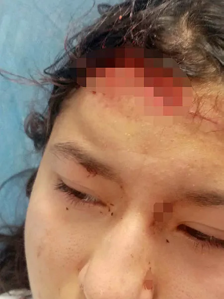 2. Asiye Ateş vakası! Kastamonu'da sokak köpekleri selfie yapan genç kızın yüzünü parçaladı-2