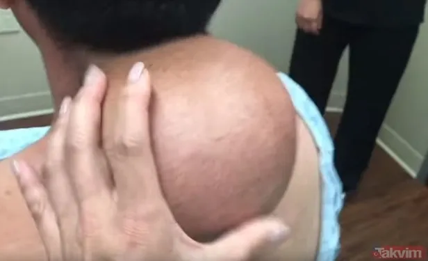 agri-sikayeti-ile-gittigi-hastanede-karnindan-9-kilo-800-gram-kitle-cikarildi-1607412942569.jpg Ağrı şikayeti ile hastaneye gitti! 18 yaşındaki kızın karnından 9 kilo 800 gram kitle çıkarıldı-4