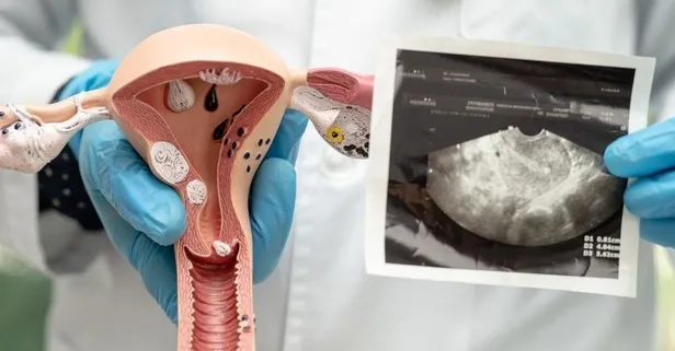 Kadınların kabusu miyom hakkında bilinmesi gerekenler!