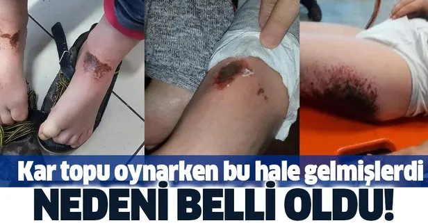 Afyonkarahisar’da kar topu oynadıktan sonra vücutlarında yanıklar oluşmuştu! Nedeni belli oldu!