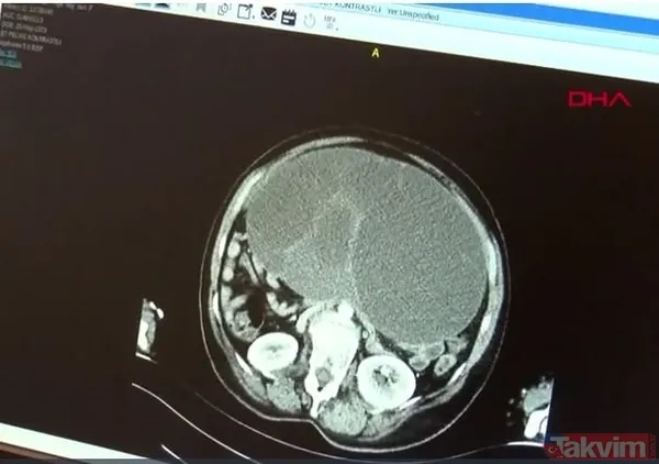 Karnındaki şişlik için gitti içinden çıkan doktorları bile şoke etti! Yer uzak değil Kayseri! 64 kilo girdi 55 kilo çıktı - 2