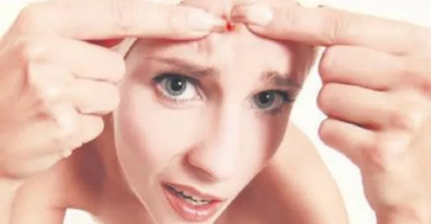 Uzmanı sivilcenin neden oluştuğunu ve tedavi yöntemlerini sıraladı!