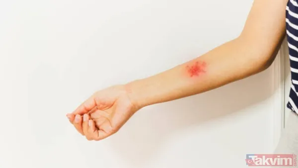 Bazı Kişilerde Kene Isırığı Bölgesinde Kısa Süreli Küçük Kızarıklık Veya Yumru Oluşabilir, Ancak Bunlar Lyme Hastalığının Belirtisi Değildir. Tedavi Edilmezse...