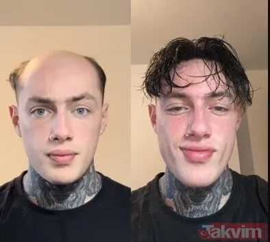 Saç Ekimi İle Kıyaslandığında Çok Daha Uygun İngiltere'de Bir Saç Ekimi İşlemi Ortalama 4.000 £ (Yaklaşık 170 Bin Tl) Civarında. Bu Rakam Birçok Kişi İçin...