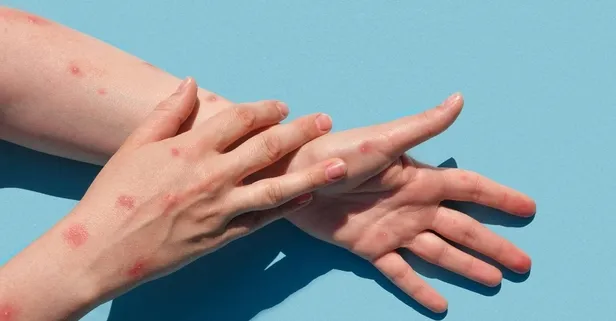 Maymun Çiçeği alarmı sonrasında herkes bunu araştırıyor! Çiçek aşısı nedir? Çiçek aşısı Türkiye'de yapılıyor mu? İşte çiçek aşısı ve Osmanlı...