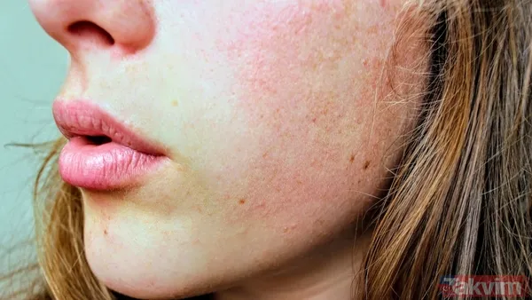 Kış aylarında cildiniz neden kuruyor? Sebebi sandığınızdan farklı - 2