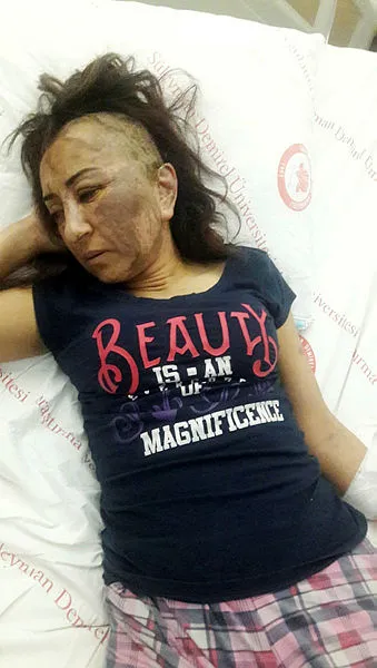 Isparta'da cani adam kendisinden boşanmak isteyen eşine kezzapla saldırdı!-2