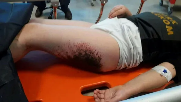 Afyonkarahisar'da kar topu oynayan çocukların üzerindeki yanıkların nedeni belli oldu!-2