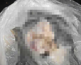 34 yıl önce karaciğerinde unutmuşlar!