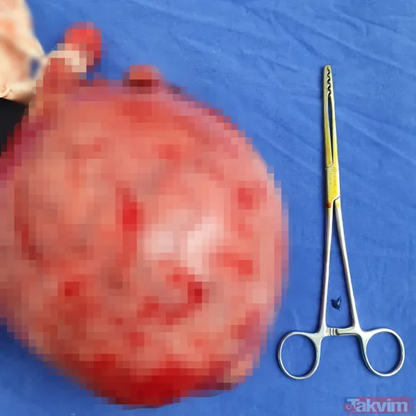 Doktorlar bile şaşırdı! Karnından 20 santimlik miyom çıktı - 5