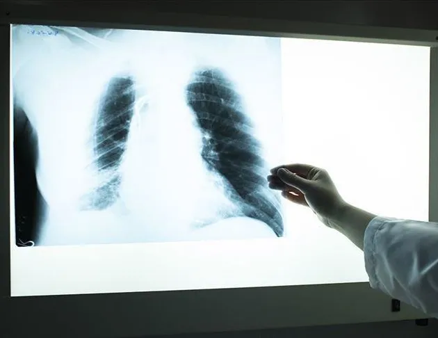 Hırıltılı nefes KOAH demek