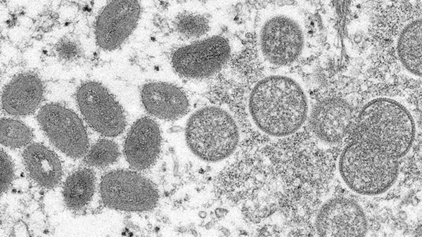 Dünya alarmda! 5 ülkede görüldü! Maymun çiçeği salgını Avrupa'yı vurdu! Maymun çiçeği hastalığı nedir, nasıl bulaşır, tedavisi var mı?-3