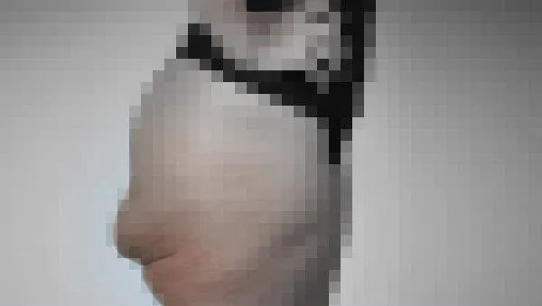 SON DAKİKA: İstanbul'da 'kalça estetiği' faciası: Brezilya kalçası istedi ölümden döndü-7