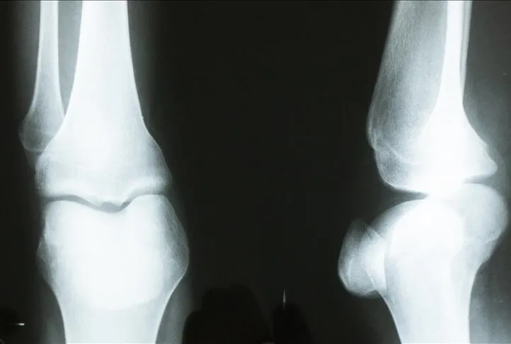 Can düşmanı kemik erimesi