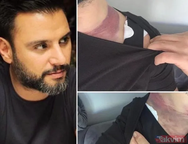 Alişan ölümden döndü soluğu eşiyle birlikte mahkemede aldı! Alişan'ın 12 milyonluk 'yağ aldırma' davasında her yeri mosmor olmuştu - 3