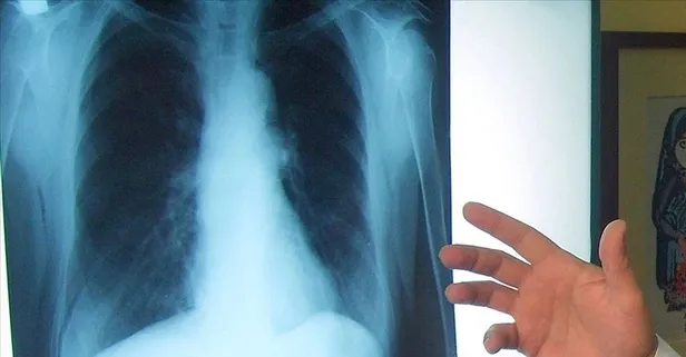 Berberin bitkisi akciğer kanserine karşı umut vadediyor