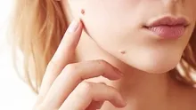 Yaz mevsimi öncesi kritik uyarı: Cilt kanseri riskini ele veren 4 sinsi işaret!