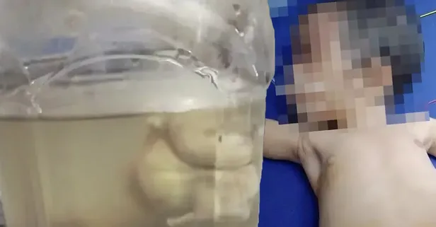 Bilim insanları dahi şaşkın! Yenidoğan bebeğin karnındaki şişliğin içinden çıkanlar kan dondurdu! Tümor sandılar ama tam 8 tane...
