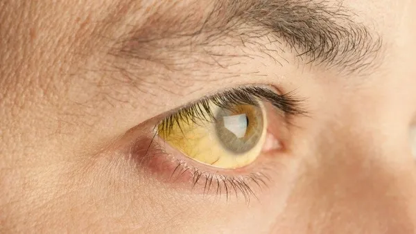 Korkunç gerçek ortaya çıktı: 10 kişiden 9'u hepatit hastası olduğundan habersiz!-3