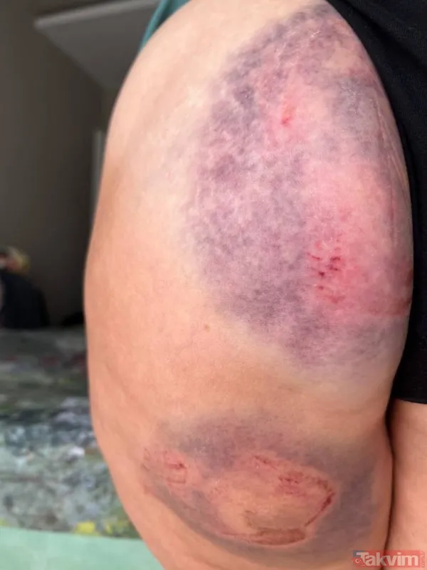 Antalya Muratpaşa'da caretta caretta Rus turistin kalçasını ısırdı - 6