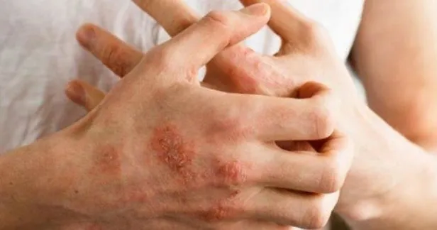 Cilt hastalıklarının temelinde sağlıksız karaciğer bulunuyor! Roka, lahana ve papatya çayı ise cildi besliyor...-3