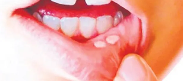 Ülser ağzınızda!