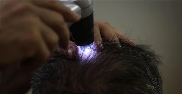 Hindistan'da "kel virüsü" salgını korkuya neden oldu