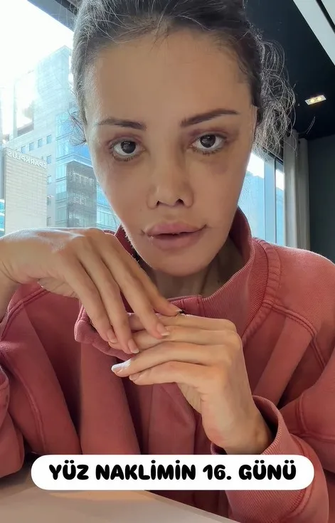 guney-korede-yuz-nakli-yaptiran-didem-ceranin-son-hali-1771060769313.jpg Güney Kore’de yüz nakli yaptıran Didem Ceran’ın son hali-6